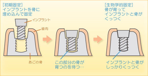 １日プラントとは？ | インプラント治療は秋田県秋田市茨島のあいば歯科