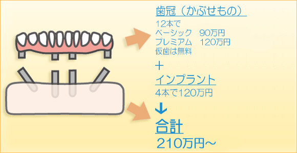 インプラント
