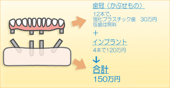 インプラント